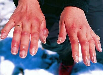 За місяць понад тисячу українців звернулись до медиків з переохолодженням та обмороженням